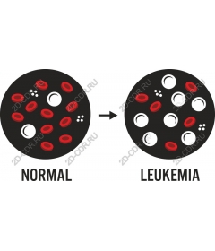  Leukemia versus normal blood cells