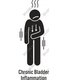  Chronic inflammation of the bladder