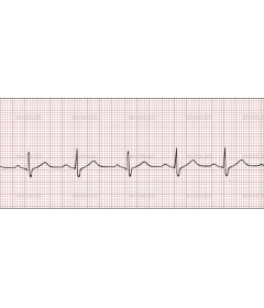 EKG1