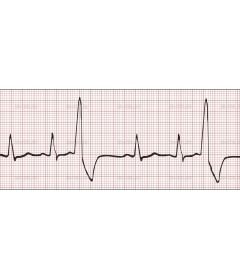 EKG2