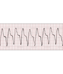 EKG3